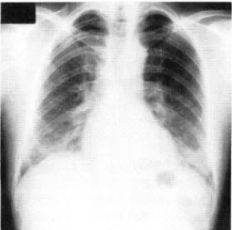 Fig.  1  Chest  x-ray  film  on  admission  shows  small  granular  shadow  and  confluent  shadows  in  the  bilateral  middle  and  lower  lung  fields.