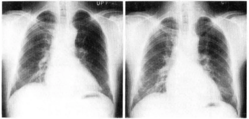 Fig.  4  Left  :  Chest  x-ray  film  before  the  provocation  test.  Right  :  Chest  x-ray  film  after  the  provocation  test  shows  small  rounded  opacities  and  confluent  shadows,  like  the  shadow  of  pulmonary  edema.