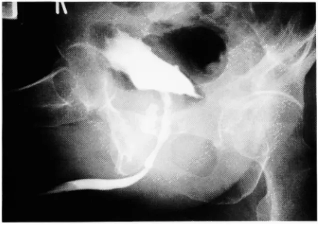 Fig.  1.  Urethrography  revealed  prostatic  ure-        thral  wall  irregular  and  little          pressed by the prostate.