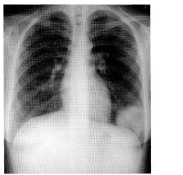 Fig.  1.  Chest  X-ray  film  on admission  shows  a  clearly  demar- demar-cated  6.2•~5.1cm  tumor  shadow  in  S8  of  the  left  lung.