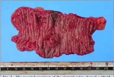 Fig. 2 The  resected  specimen  of  the  sigmoid  colon  showed  a  19×15- 19×15-mm type 1 tumor.