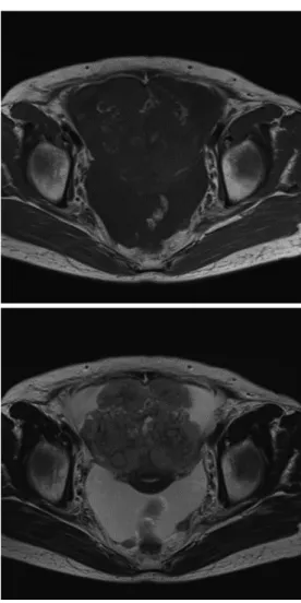 Fig. 2　MRI : As on CT, there is a soft mass ad- ad-mixed to the ventral side of the uterus and  blad-der-head side （ａ : T1W1, ｂ : T2W1）.