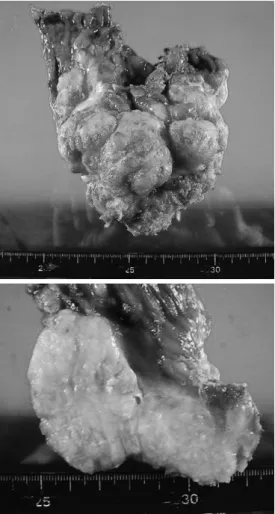 Fig. 4　Resected specimen : ａ） The tumor is 140  mm×90 mm.  ｂ） The cut specimen is a  white-colored, lobulated, solid tumor.