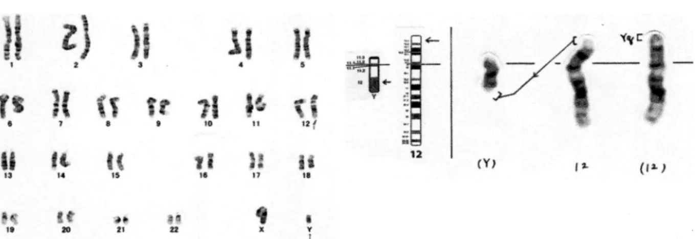 Fig. 1. G banding pattern of peripheral lymphocytes. Arrows indicate the translocated chromosome