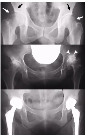 図 2  臼蓋形成不全を伴った家族性変形性股関節症の大家系のレントゲン像（股関節 正面像） 上段 :変形性股関節症発症前。臼蓋形成不全、すなわち、大腿骨頭（白矢印）を臼蓋 （黒矢印）が十分に被っていない状態がみられる。 38 歳、男。  中段 :末期の変形性股関節症。軟骨がなくなり、関節間の隙間が亡くなってしまって いる。大腿骨頭の変形、過剰な骨の形成（白矢頭）もみられる。 55 歳、女。  下段 :両側人工関節置換術後。56 歳、女。 