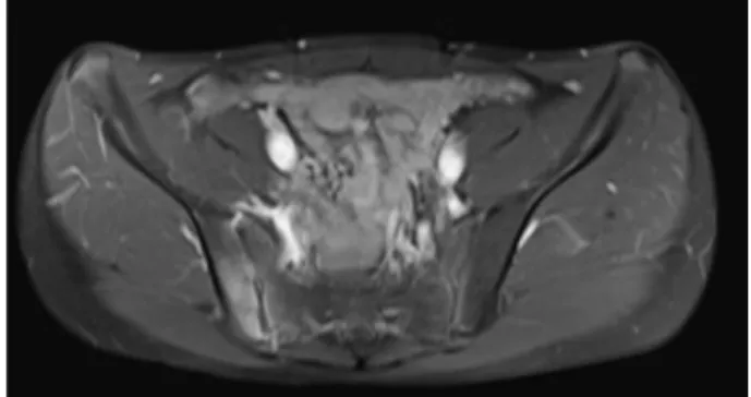 図 1 骨盤部単純 MRI 検査（症例 1）T1 脂肪抑制．右仙腸 関節に接する仙椎と腸骨に集積を認め，仙腸関節炎と 診断した．明らかなびらん，骨破壊は見られなかった．I.は じ め に血清反応陰性脊椎関節炎は中心性および末梢関節に関わる慢性関節炎でリウマトイド因子陰性，抗核抗体陰性であり，HLA-B27 と強い相関が見られる1)．小児例は初期に成人で用いられる診断基準2)に合致することは少なく，当初は末梢関節炎で始まり，やがて脊椎炎や腰臀部関節炎などの中心性関節炎および付着部炎に移行する例も多い3)．脊