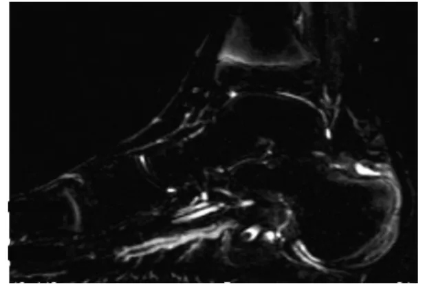 図 2 右足部単純 MRI 検査（症例 2）STIR．アキレス腱付 着部の踵骨部に淡い信号上昇を認め，少量の eŠusion を伴っており，アキレス腱付着部炎と診断した． 図 3 FDG-PET 検査（症例 1）踵骨，脛骨遠位，脛骨近位 に集積を認めた2.症例 2症例 2 は 9 歳男児．父方の祖母が関節リウマチに対してトシリズマブを投与されており，父には青年期より強い腰痛がある．9歳 5 か月時両肩関節，両足関節，両膝関節に疼痛が出現し，左膝関節痛が増強し 9 歳 11 か月時より 38°Cの弛張熱，