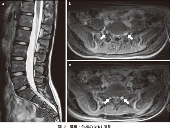 図　2　腰椎・仙椎の MRI 所見 a. T2WI: 腰椎アライメントは正常である． b・c. T1WIGd 造影脂肪抑制: 左 S1 神経根の腫大，両 側 L5 と S1 神経根の造影効果が目立つ（矢印）．bc 表 2　末梢神経伝導速度検査 ＜運動神経伝導速度＞ 遠位潜時 [msec] 伝導速度 [m/s] CMAP 振幅 [mV] 正中神経   6.36   （2.6±0.3）   （57.2±3.7）50.5   （8.8±1.9）4.65 尺骨神経   5.31   （2.3±0.3）   （58.