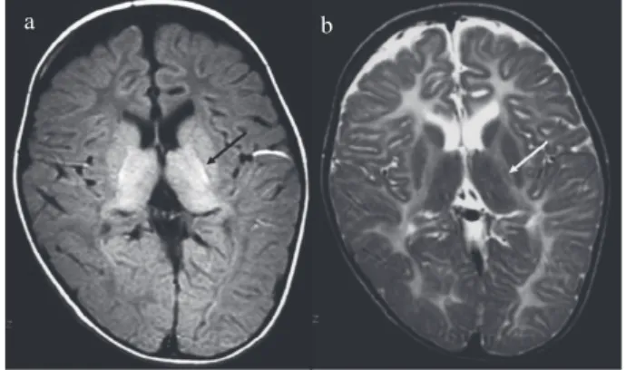 図 7 Diffuse cerebral hypomyelination with cerebellar atrophy  and hypoplasia of the corpus callosum （HCAHC，POLR3B  遺伝子異常を認める） 26 歳男性，発達遅滞，性腺機能低下を認める．T2 強調画像で大脳白質 高信号，併せて小脳萎縮，脳梁低形成を認める．ab図 4 Pelizaeus-Merzbacher disease（先天型，PLP1 遺伝子点変異 Pro 210 Leu）12 歳男児a ：