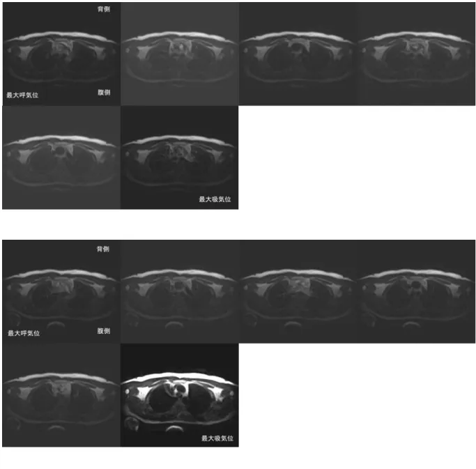 図 11  冠 状 断 MRI 画 像  
