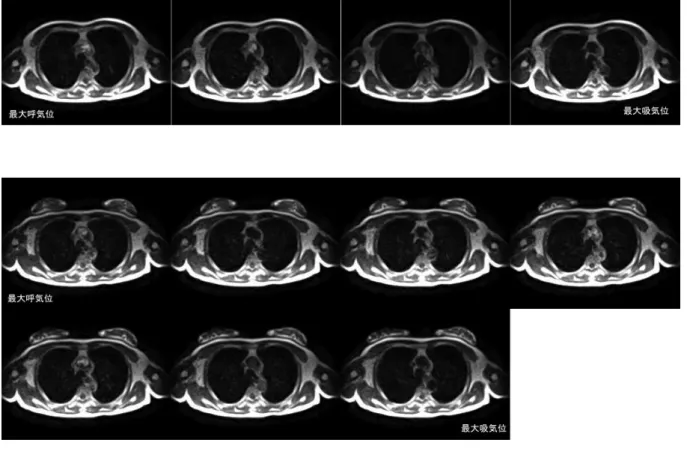 図 15  水 平 断 MRI 画 像  