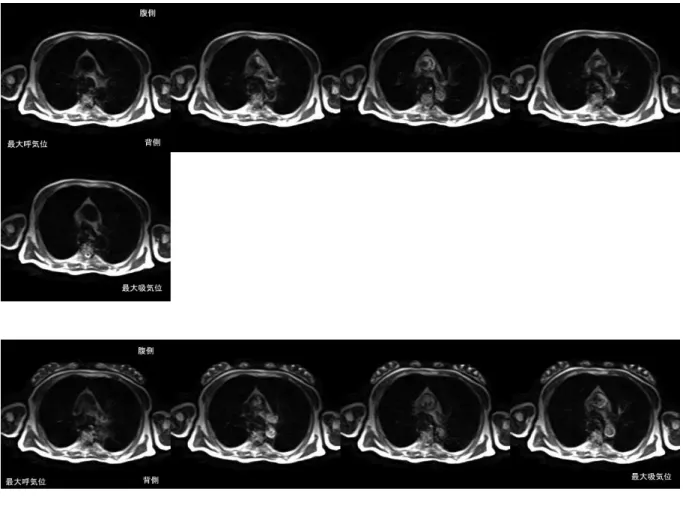 図 23  水 平 断 MRI 画 像  