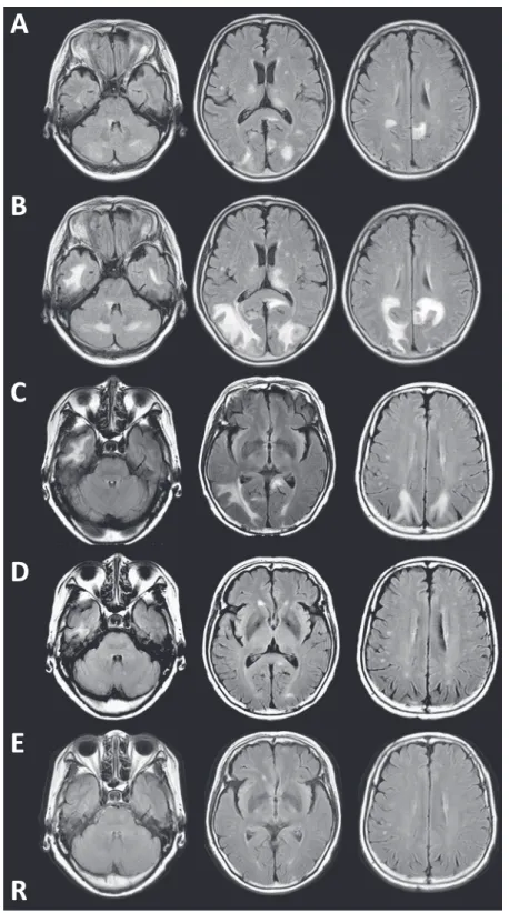 Fig. 2 Sequential changes on brain MR imaging in this case.