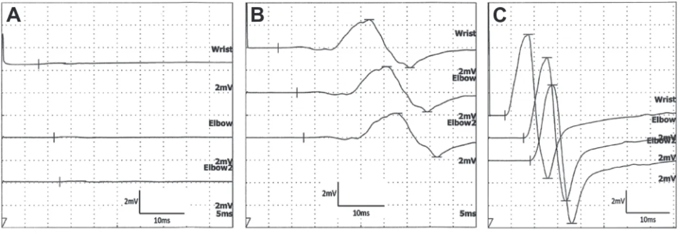 Fig. 1 The nerve conduction study of right ulnar motor nerve.