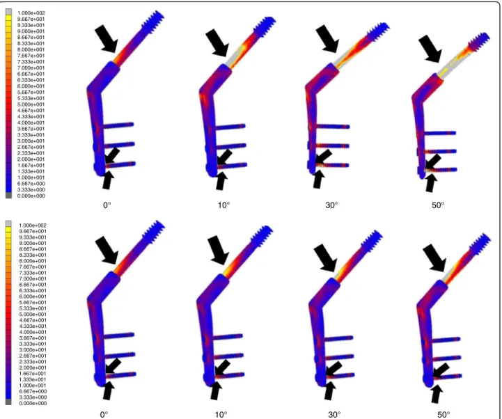 Fig. 5 Maximum values of the von Mises stress distribution at SHS. The upper section shows the non-displaced two-fragment fracture model and type A models