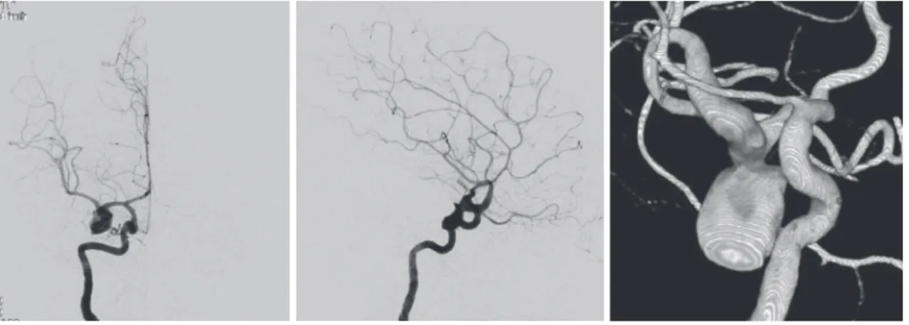 Fig. 3  Computed tomography (CT) image (A) showing subarachnoid hemor- hemor-rhage with ventricular rupture