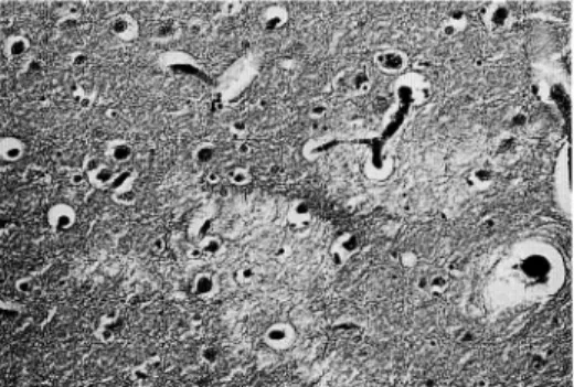 Fig. 3 : Largermagnification of pallor spots. A capillary runs in the affected area. Case 2,