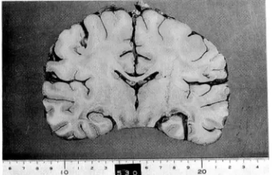 Fig. 5 : Cut surface of the brain of Case 3. Marked congestion of the super surface veins and
