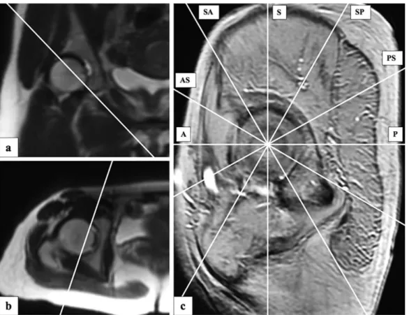Fig.  2：Procedure  for  the  construction  of  radial  planes.　First,  the  plane  across  the  acetabular  opening  was  selected  in  coronal  （a） and  axial  （b）  slices.　Subsequently,  the  reference  parasagittal  plane  image  tangential to the aceta