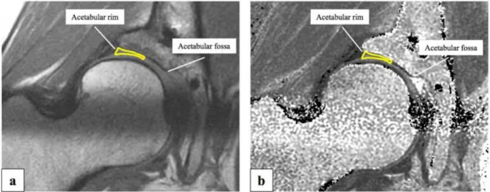 Fig.  3：T2  mapping  image  on  the  second  echo（a）and  T2  mapping  preset  image（b） .　The  acetabular  cartilage  was  defined  as  the  region  between  the  acetabular  rim  and  acetabular  fossa.　The  acetabular  cartilage  was  bisected  and  the  