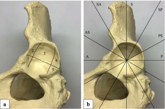 Fig. 7：Bone model of the left hip showing the geographical zone method of Ilizaliturri et al