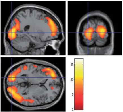 Fig. 1  ： Brain regions with hypoperfusion in patients with DLB （ n ＝ 28 ） compared  with NC  （ n ＝ 32 ） using SPM analysis of cerebral perfusion SPECT.