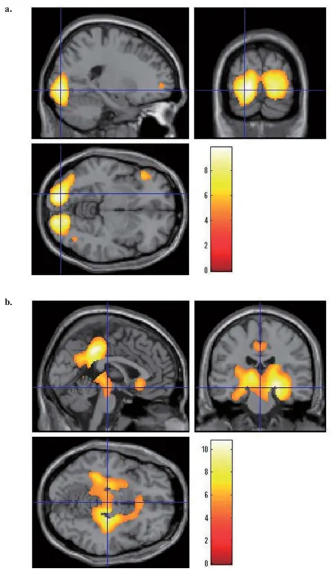 Fig. 2 ： Brain regions with hypoperfusion in patients with DLB （ n ＝ 28 ） com-  pared with AD  （ n ＝ 37 ）  using SPM analysis of cerebral perfusion SPECT.
