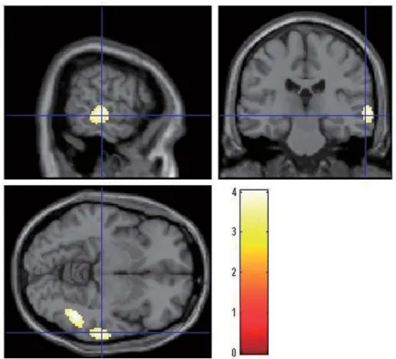 Fig. 4 ： Brain regions with hypoperfusion in patients with depressive symptoms 