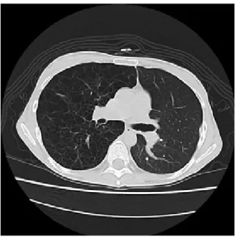 図 4  LAM に対する左片肺移植後の CT 像 　 右側の LAM 肺は瀰漫性に薄壁の嚢胞を形成しており，典 型的な LAM 肺の所見．左側の移植肺は正常所見を呈して いる．右肺の気腫化のため縦隔の左方シフトがおこっている． 図 6  特発性間質性肺炎に対する左片肺移植後の肺 3DCT 像 　 線維化の著しい右自己肺はイクラ状の表面外観を呈し，体積も著しく縮小している．それに対して左の移植肺はスムースな表面を呈し，サイズも著しく大きい． 図 5  LAM に対する左片肺移植後の肺換気血流スキャン 　 9