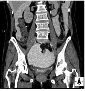 図 1  腹部〜骨盤部造影 CT で大量の腹水貯留がみられた . 図 2  造影 CT から 12 時間後の腹部〜骨盤部単純 CT で腹水が淡く造影されていた．この所見から腹膜内膀胱破裂と診断した．— 166 —緒　　　　　言膀胱破裂は破裂形式により腹膜外破裂と腹膜内破裂に分けられる．両者の治療は，腹膜外破裂ならば尿道カテーテル留置による尿のドレナージ，腹膜内破裂ならば開腹して膀胱裂傷部を縫合閉鎖することが原則とされている．しかし，腹膜内膀胱破裂に対して保存的治療で治癒した症例も報告されている1）2）3）．