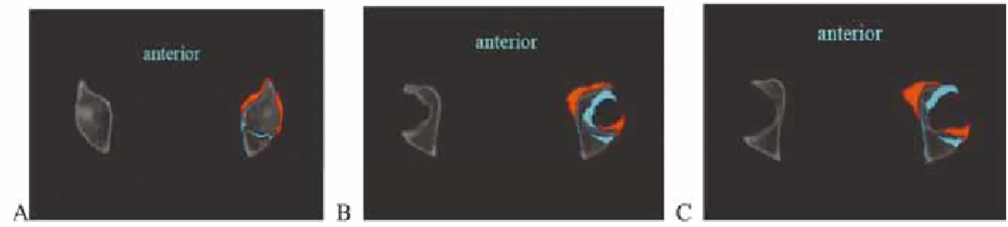 Fig. 3   （A,B and C）  Images are a series of axial slices. Areas indicated in blue are preoperative sections, while the reoriented acetabular  fragments are indicated in red.