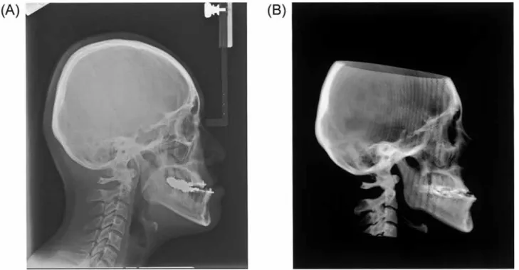 Fig. 4   Cephalometric radiograph of jaw deformity patient. 