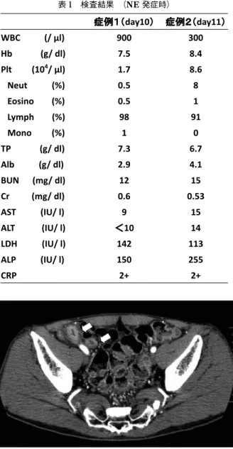 表 1  検査結果 （ NE  発症時） 図 2   腹部造影 CT 7cm に腫大した虫垂を認める（矢印）．内腔 に液の貯留を疑わせる． 図 3  a）  手術標本    7cm に発赤腫大した壁の肥厚を伴う虫垂．一部    腸間膜方向へ穿通を認める（矢印）． b）  a）  の手術標本（虫垂）の組織像 腸管壁内にリンパ球を主 体とする浸潤（矢印）が認められる．HE 染色 x100． c）  b）  図の矢印部位の強拡大 リンパ球を主体とする浸潤を認 め，好中球はほとんど認められない．白血病細胞は認めら 