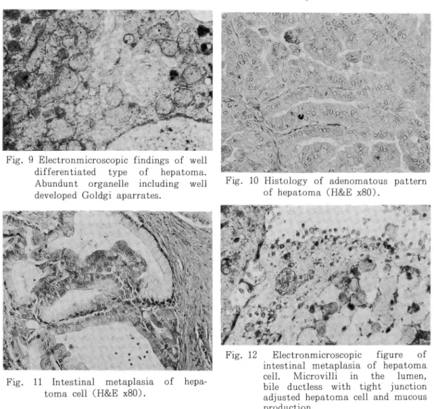 Fig. 8 Histology of well differerntiated type of hepatoma (H&amp;E x80)o