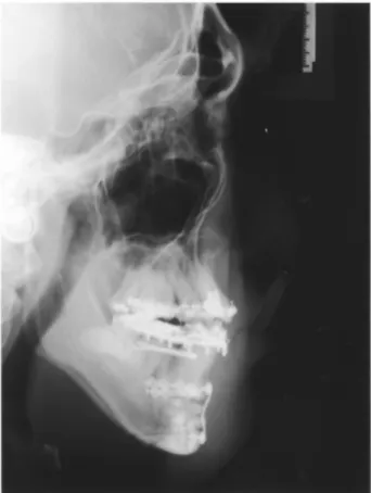 Figure ３. postsurgical lateral cephalogram