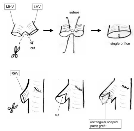 Fig.  3. Biliary  reconstruction. A  duct  to  duct  anastomosis  between  the  left hepatic duct of the recipient and the hepatic duct of the partial  liver graft. A single layer interrupted suture is applied using 4 0  or 5 0 absorbable suture. The bilia