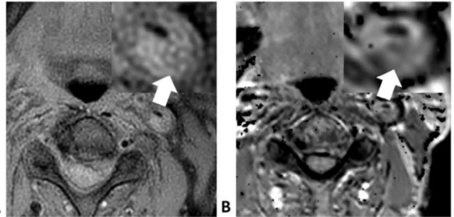 Figure 4. Left carotid stenosis in a 78-year-old man. The plaque is slightly hyperintense with respect to adjacent muscle on T1-weighted image scans (A, arrow)