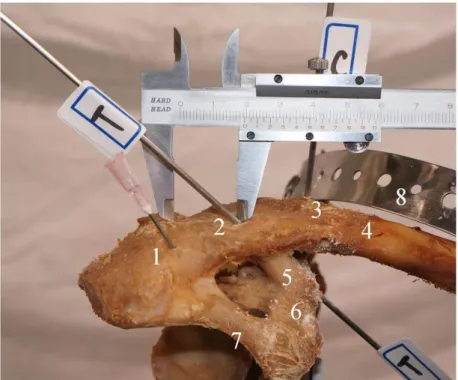 Fig.  1A.  Distance  from  the  lateral  edge  of  the  clavicle  to  the  K-wire  insertion  in  the  trapezoid ligament