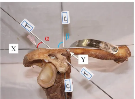 Fig. 1B. Coronal view of the right shoulder. X: horizontal baseline; reference K-wire set  along  the  longitudinal  axis  of  the  clavicle  passing  the  anteroposterior  midpoint  of  the  distal and proximal clavicle; Y: reference K-wire drilled from t