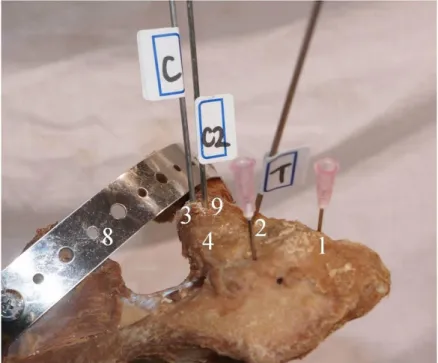 Fig.  1D.  C2:  second  conoid  K-wire  inserted  at  the  midpoint  of  the  anteroposterior  diameter of the clavicle on a line perpendicular to reference X and parallel to  wire-C; 9: insertion point of the second conoid K-wire