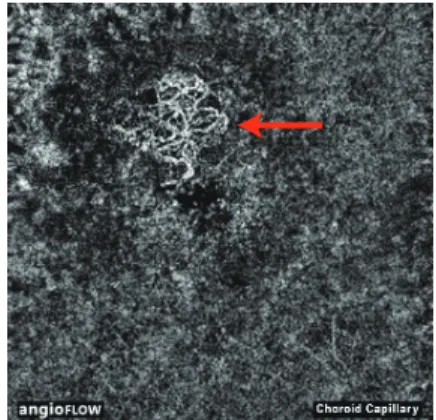 図 3：Outer Retina 表示の CNV 画像（Type 2 治療前）
