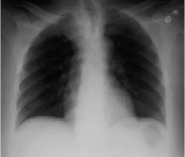 Figure 1. Patient with tracheal obstruction/deviation due to non–small cell lung carcinoma in the right upper lobe.