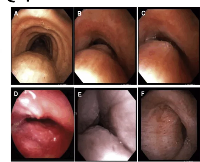 Figure 3 – Morphological types of expiratory central airway collapse. A, Normal, physiologic dynamic airway compression (DAC)