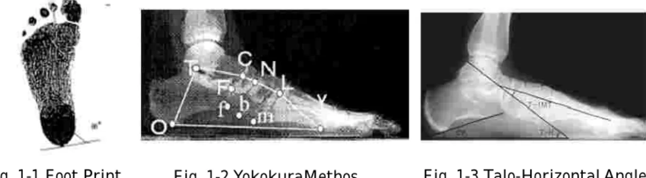 Fig. 1-1 Foot Print Fig. 1-2 YokokuraMethos Fig. 1-3 Talo-Horizontal Angleる。しかしながらジャンプの着地動作時の足部と膝関節の挙動の関係について検討した研究、特に着地時に傷害発症が多いバスケットボール選手を対象としたものは認められない。従ってバスケットボールにおいて着地時に好発する膝関節傷害予防方針を構築するためにも、ジャンプ着地時の足部と膝関節の挙動の関連について明らかにすることは必須であると考えられる。 足部形態計測の先行研究 一