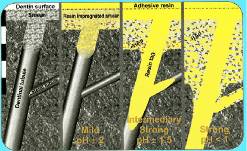 Fig. 1-2 Schematic overview of the interaction of different self-etch adhesives with  dentin
