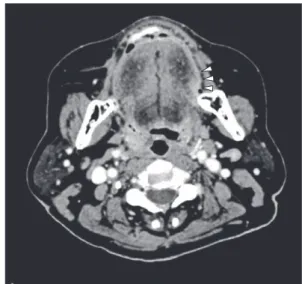 Fig. 1　 At the first visit, a 15 × 8 mm cauliflower-like  tumor with surrounding induration was observed  on the left side of the tongue.