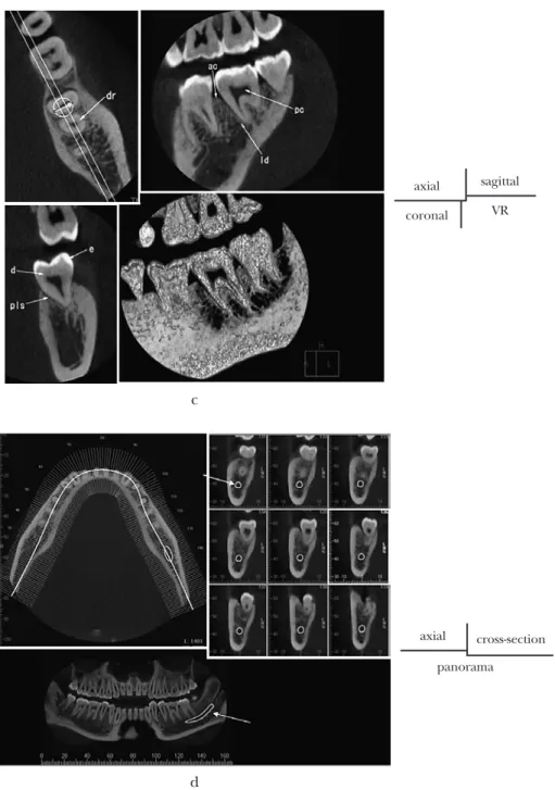 Fig. 4 Anatomical structures on MPR image and dental reformatted images a: Maxillary and mandibular bone on MPR image using I-mode.