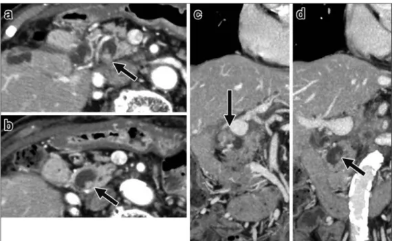 Fig. 6 a: ERCP detected multiple filling defects in the proximal to distal common bile duct