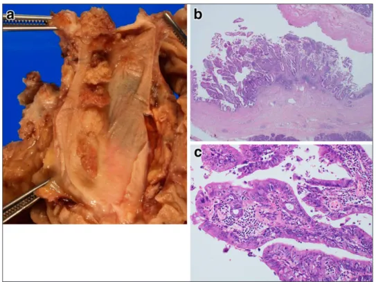 Fig. 7 Histopathological findings of second surgery. a: There were eight papillary tumors bunching in a row in the common bile duct lumen