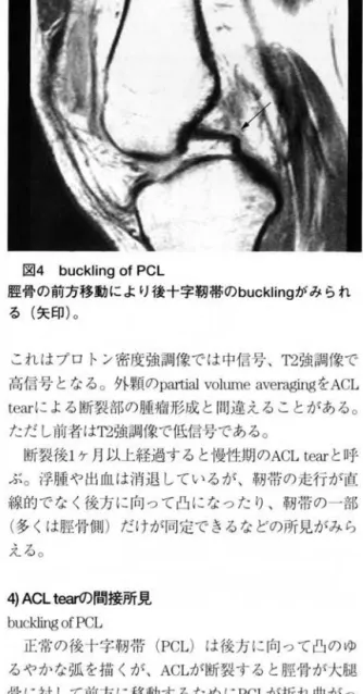 図 3 前十字靭帯断裂急性期